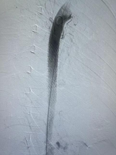 gore医疗怎么样How I Do It ｜ 张雷杨教授团队：Gore VBX用于儿童主动脉食管瘘治疗一例分享_https://www.jmylbn.com_新闻资讯_第5张