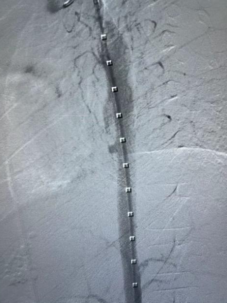 gore医疗怎么样How I Do It ｜ 张雷杨教授团队：Gore VBX用于儿童主动脉食管瘘治疗一例分享_https://www.jmylbn.com_新闻资讯_第4张