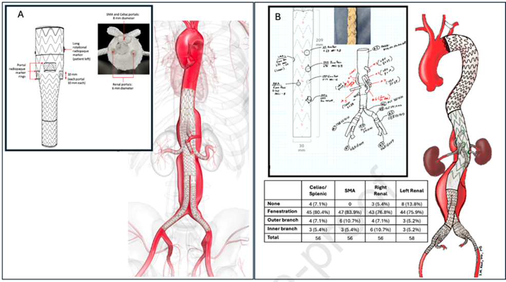 gore医疗怎么样GORE TAMBE与PMEG治疗复杂胸腹主动脉瘤的3年随访结果_https://www.jmylbn.com_新闻资讯_第6张