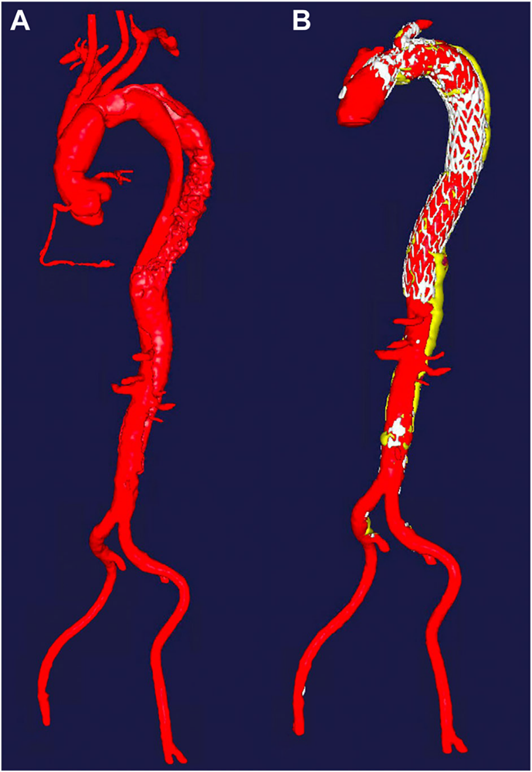 gore医疗怎么样GORE TAG分支型胸主动脉覆膜支架治疗Stanford B型主动脉夹层的中期临床结果_https://www.jmylbn.com_新闻资讯_第7张