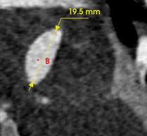动脉长鞘怎么置入宁波市第二医院血管外科运用Castor®单分支支架结合长鞘建立导丝通路的方法治疗Stanford B型胸主动脉夹层一例_https://www.jmylbn.com_新闻资讯_第5张