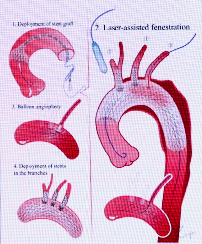 动脉长鞘怎么置入张鸿坤教授《胸主动脉腔内修复弓部开窗的专家共识》_https://www.jmylbn.com_新闻资讯_第5张