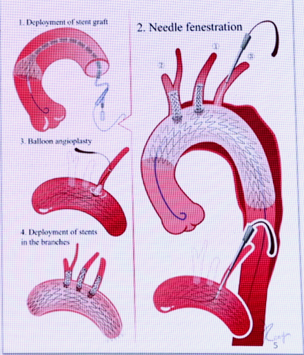 动脉长鞘怎么置入张鸿坤教授《胸主动脉腔内修复弓部开窗的专家共识》_https://www.jmylbn.com_新闻资讯_第4张