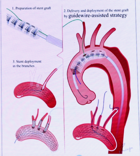 动脉长鞘怎么置入张鸿坤教授《胸主动脉腔内修复弓部开窗的专家共识》_https://www.jmylbn.com_新闻资讯_第8张