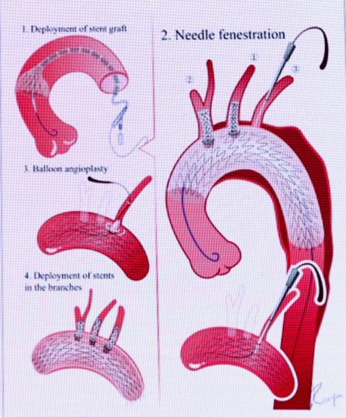 动脉长鞘怎么置入张鸿坤教授《胸主动脉腔内修复弓部开窗的专家共识》_https://www.jmylbn.com_新闻资讯_第6张