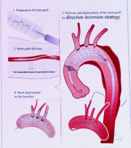 动脉长鞘怎么置入张鸿坤教授《胸主动脉腔内修复弓部开窗的专家共识》_https://www.jmylbn.com_新闻资讯_第7张