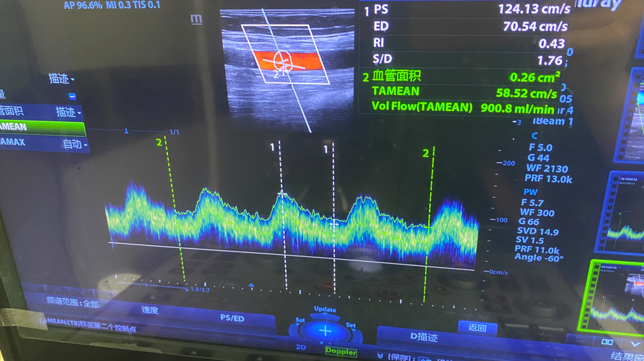 pta在医学上什么意思鼎例相助 ｜ 张和平教授团队：刻痕药涂球囊的应用体会_https://www.jmylbn.com_新闻资讯_第19张