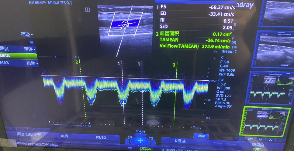 pta在医学上什么意思鼎例相助 ｜ 张和平教授团队：刻痕药涂球囊的应用体会_https://www.jmylbn.com_新闻资讯_第6张