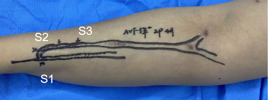 pta在医学上什么意思鼎例相助 ｜ 张和平教授团队：刻痕药涂球囊的应用体会_https://www.jmylbn.com_新闻资讯_第7张