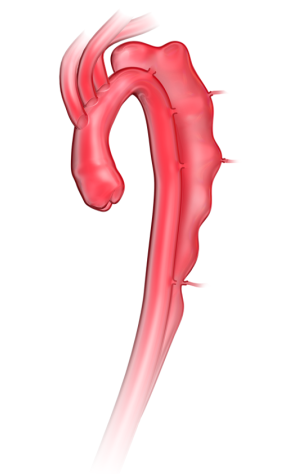gore医疗怎么样「胸有乾坤」危如累卵 妙手回春——Conformable GORE®TAG®胸主动脉覆膜支架应用于高龄急性主动脉夹层治疗_https://www.jmylbn.com_新闻资讯_第6张