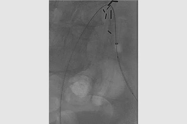 gore医疗怎么样首批患者已入组GORE VBX FORWARD临床研究——VBX支架与裸金属支架在治疗髂动脉闭塞性疾病中的比较_https://www.jmylbn.com_新闻资讯_第5张