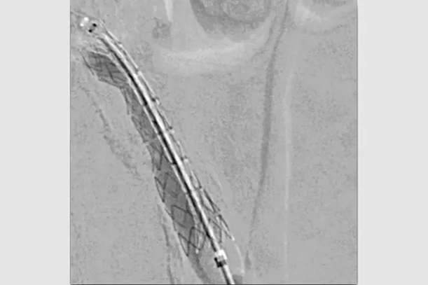 gore医疗怎么样首批患者已入组GORE VBX FORWARD临床研究——VBX支架与裸金属支架在治疗髂动脉闭塞性疾病中的比较_https://www.jmylbn.com_新闻资讯_第6张