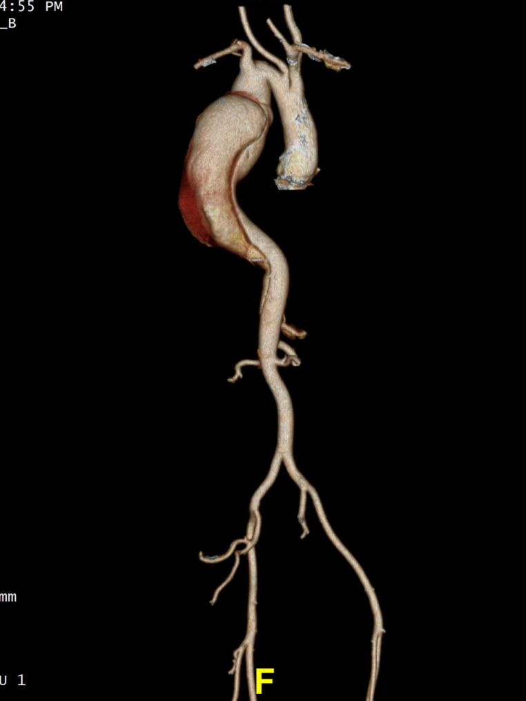 gore医疗怎么样「胸有乾坤」可调可控 精准出击——四川大学华西医院肖正华教授团队：CADS治疗B型主动脉夹层病例分享_https://www.jmylbn.com_新闻资讯_第7张