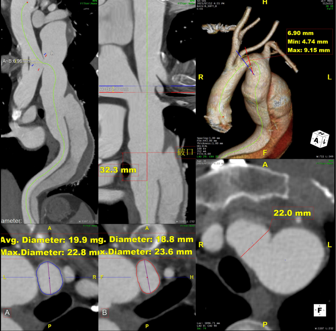 gore医疗怎么样「胸有乾坤」可调可控 精准出击——四川大学华西医院肖正华教授团队：CADS治疗B型主动脉夹层病例分享_https://www.jmylbn.com_新闻资讯_第12张