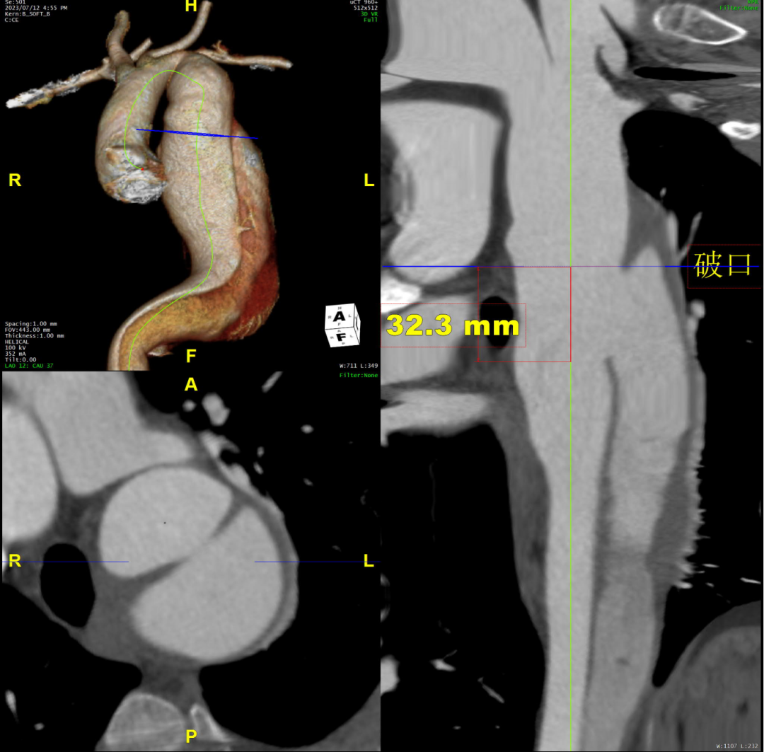 gore医疗怎么样「胸有乾坤」可调可控 精准出击——四川大学华西医院肖正华教授团队：CADS治疗B型主动脉夹层病例分享_https://www.jmylbn.com_新闻资讯_第9张