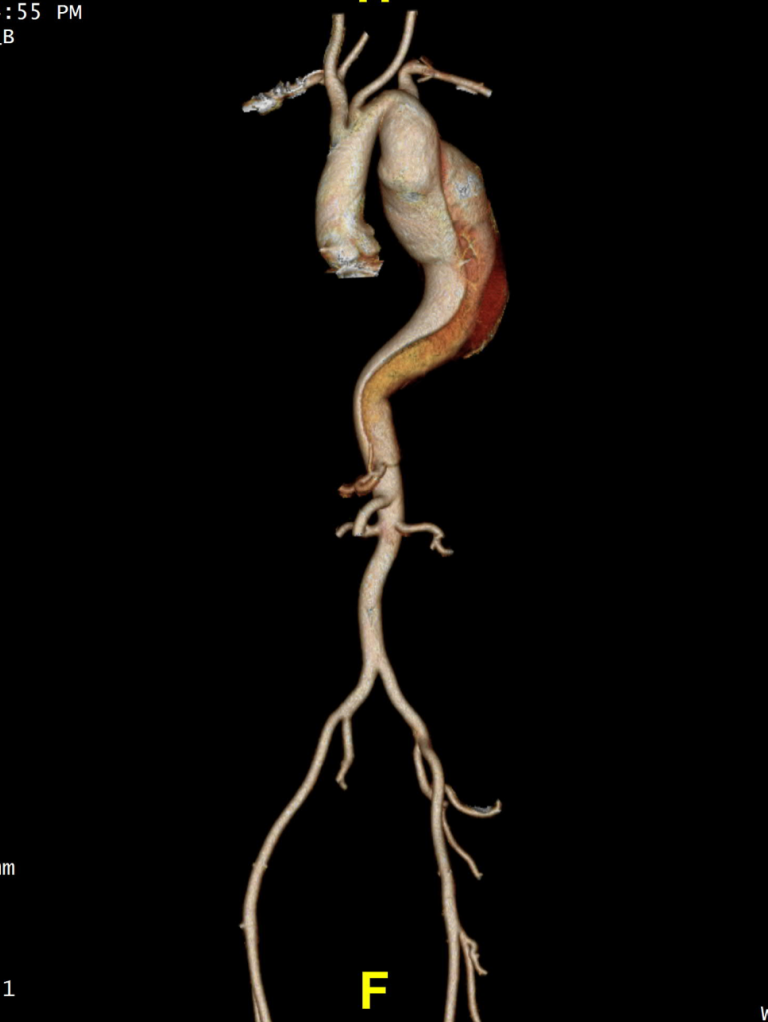 gore医疗怎么样「胸有乾坤」可调可控 精准出击——四川大学华西医院肖正华教授团队：CADS治疗B型主动脉夹层病例分享_https://www.jmylbn.com_新闻资讯_第6张