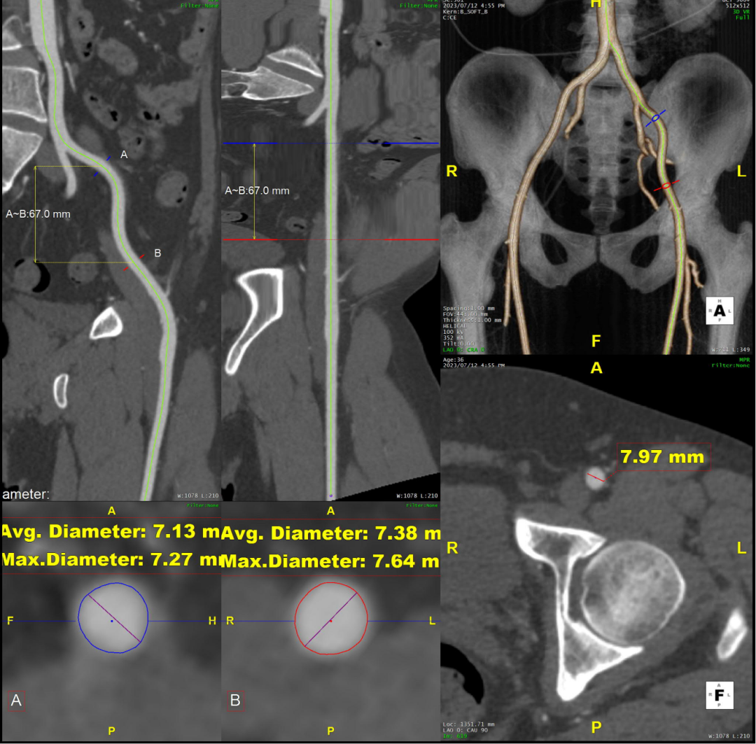 gore医疗怎么样「胸有乾坤」可调可控 精准出击——四川大学华西医院肖正华教授团队：CADS治疗B型主动脉夹层病例分享_https://www.jmylbn.com_新闻资讯_第18张