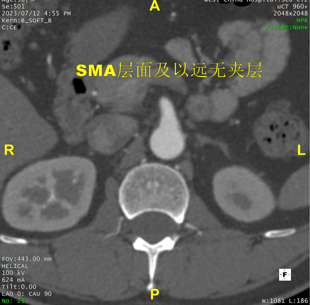gore医疗怎么样「胸有乾坤」可调可控 精准出击——四川大学华西医院肖正华教授团队：CADS治疗B型主动脉夹层病例分享_https://www.jmylbn.com_新闻资讯_第16张