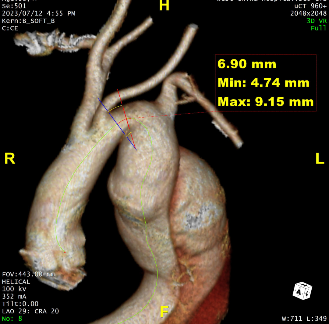 gore医疗怎么样「胸有乾坤」可调可控 精准出击——四川大学华西医院肖正华教授团队：CADS治疗B型主动脉夹层病例分享_https://www.jmylbn.com_新闻资讯_第11张