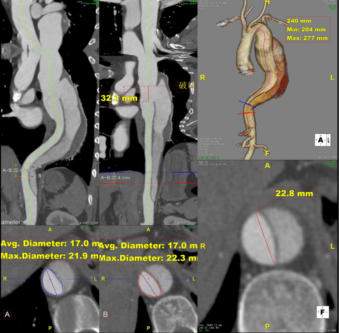 gore医疗怎么样「胸有乾坤」可调可控 精准出击——四川大学华西医院肖正华教授团队：CADS治疗B型主动脉夹层病例分享_https://www.jmylbn.com_新闻资讯_第10张