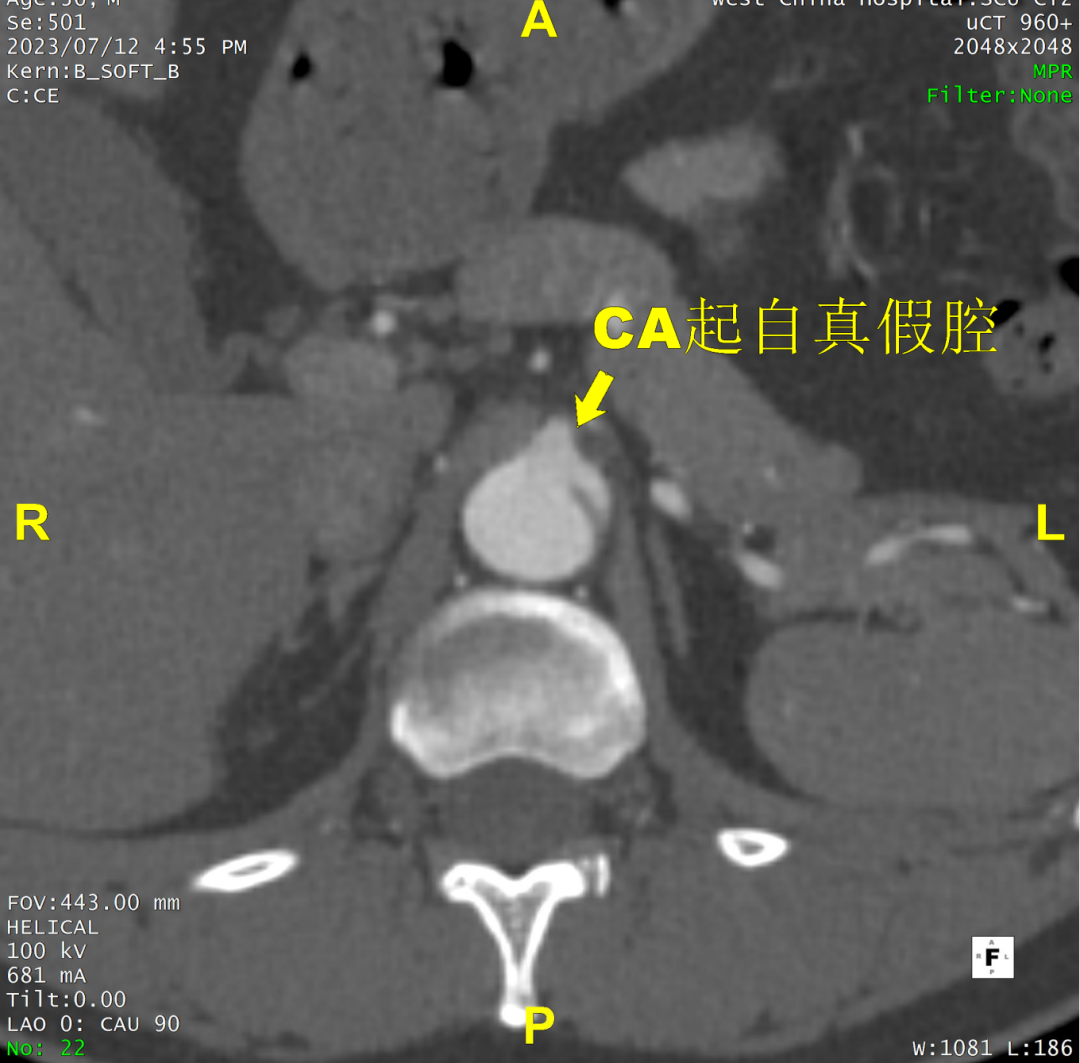 gore医疗怎么样「胸有乾坤」可调可控 精准出击——四川大学华西医院肖正华教授团队：CADS治疗B型主动脉夹层病例分享_https://www.jmylbn.com_新闻资讯_第15张