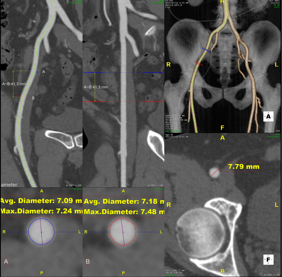 gore医疗怎么样「胸有乾坤」可调可控 精准出击——四川大学华西医院肖正华教授团队：CADS治疗B型主动脉夹层病例分享_https://www.jmylbn.com_新闻资讯_第17张