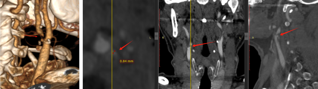 波科支架怎么样波科@CEC2025｜TCAR新技术手术交流会精彩荟萃_https://www.jmylbn.com_新闻资讯_第8张
