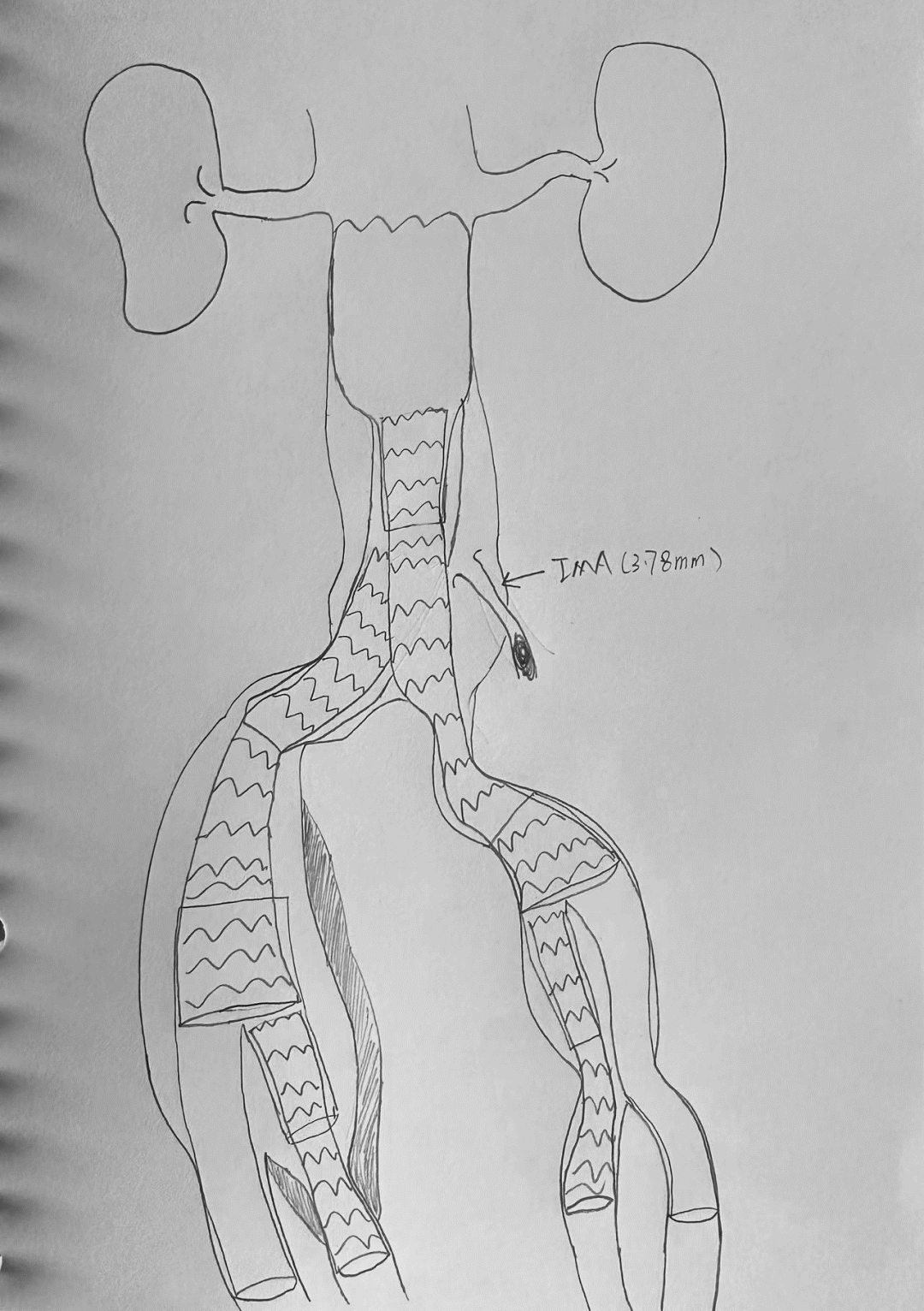 gore医疗怎么样「漫腹精论」双股动脉入路，纯腔内保双髂——GORE® EXCLUDER® 髂动脉分支型覆膜支架（IBE）治疗双侧髂总动脉_https://www.jmylbn.com_新闻资讯_第11张