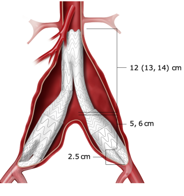 gore医疗怎么样「漫腹精论」双股动脉入路，纯腔内保双髂——GORE® EXCLUDER® 髂动脉分支型覆膜支架（IBE）治疗双侧髂总动脉_https://www.jmylbn.com_新闻资讯_第9张