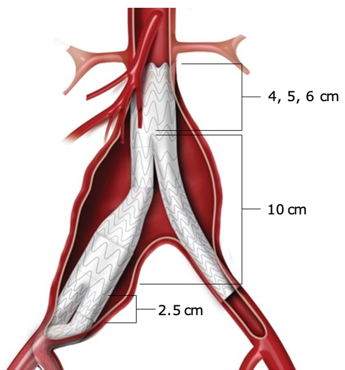 gore医疗怎么样「漫腹精论」双股动脉入路，纯腔内保双髂——GORE® EXCLUDER® 髂动脉分支型覆膜支架（IBE）治疗双侧髂总动脉_https://www.jmylbn.com_新闻资讯_第8张
