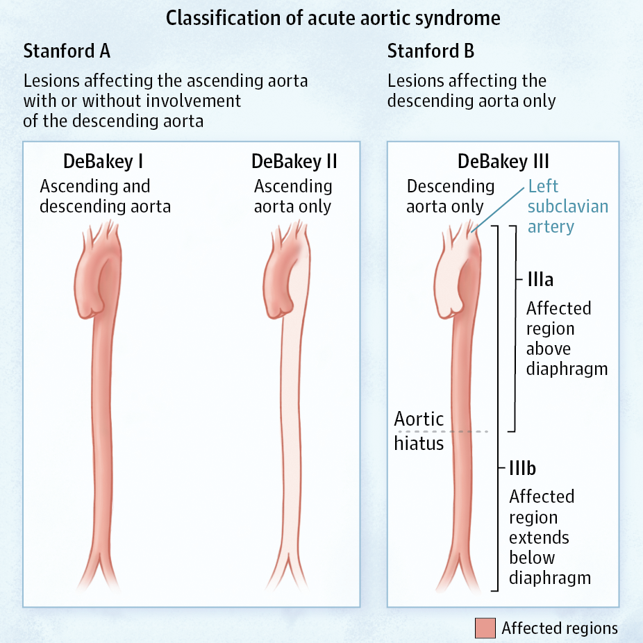 gore医疗怎么样「胸有乾坤」异“区”同“功” 精准定位——GORE® TAG® 可主动调控胸主动脉覆膜支架治疗升主动脉穿透性溃疡病例报道_https://www.jmylbn.com_新闻资讯_第6张