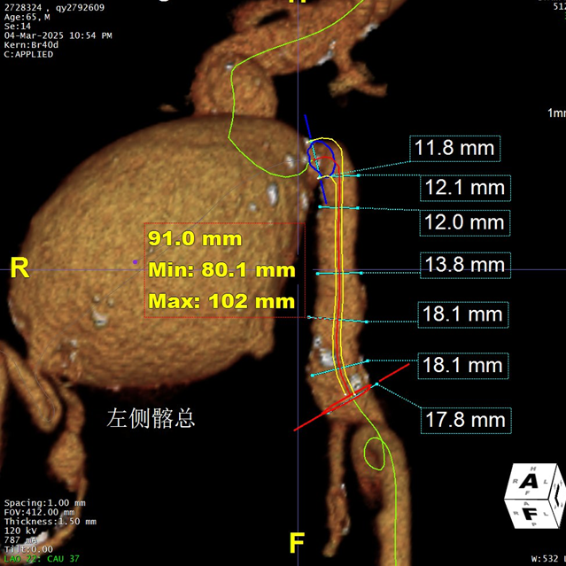 gore医疗怎么样「漫腹精论」髂合时宜 精益求精——双MOB球囊导管辅助腹主动脉覆膜支架急诊治疗破裂巨大髂动脉瘤_https://www.jmylbn.com_新闻资讯_第10张