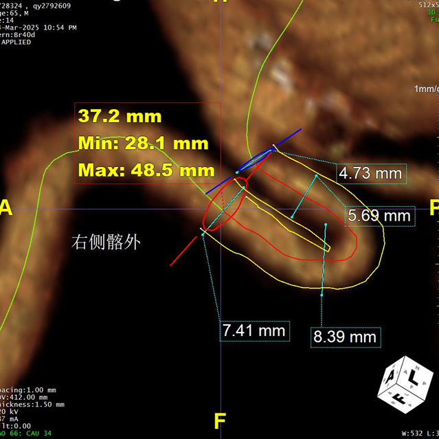 gore医疗怎么样「漫腹精论」髂合时宜 精益求精——双MOB球囊导管辅助腹主动脉覆膜支架急诊治疗破裂巨大髂动脉瘤_https://www.jmylbn.com_新闻资讯_第9张