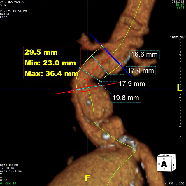 gore医疗怎么样「漫腹精论」髂合时宜 精益求精——双MOB球囊导管辅助腹主动脉覆膜支架急诊治疗破裂巨大髂动脉瘤_https://www.jmylbn.com_新闻资讯_第8张