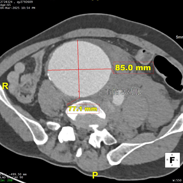 gore医疗怎么样「漫腹精论」髂合时宜 精益求精——双MOB球囊导管辅助腹主动脉覆膜支架急诊治疗破裂巨大髂动脉瘤_https://www.jmylbn.com_新闻资讯_第7张