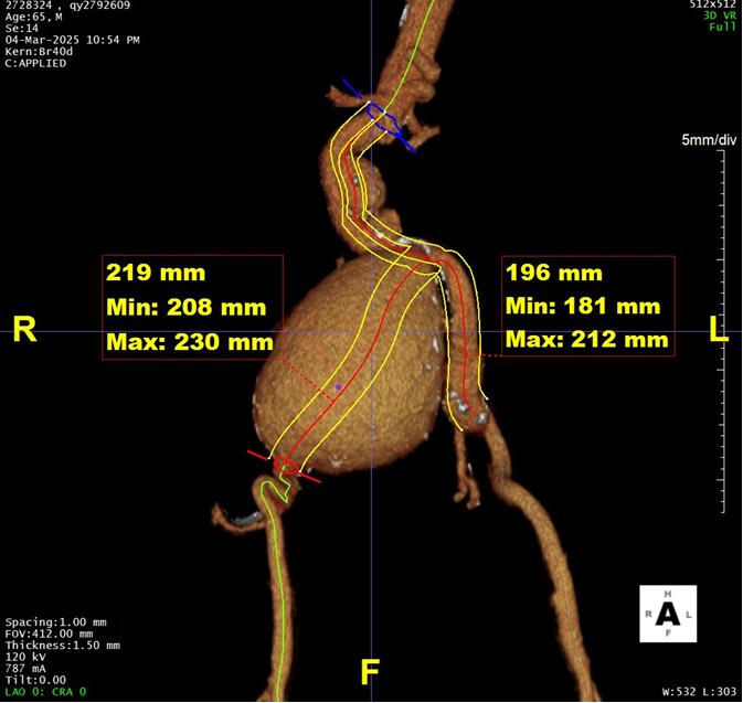 gore医疗怎么样「漫腹精论」髂合时宜 精益求精——双MOB球囊导管辅助腹主动脉覆膜支架急诊治疗破裂巨大髂动脉瘤_https://www.jmylbn.com_新闻资讯_第11张