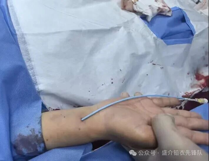 桡动脉鞘怎么读桡胜一筹丨牛猛教授团队：应用Brite Tip RADIANZ长鞘经桡动脉入路治疗脾动脉瘤一例_https://www.jmylbn.com_新闻资讯_第10张