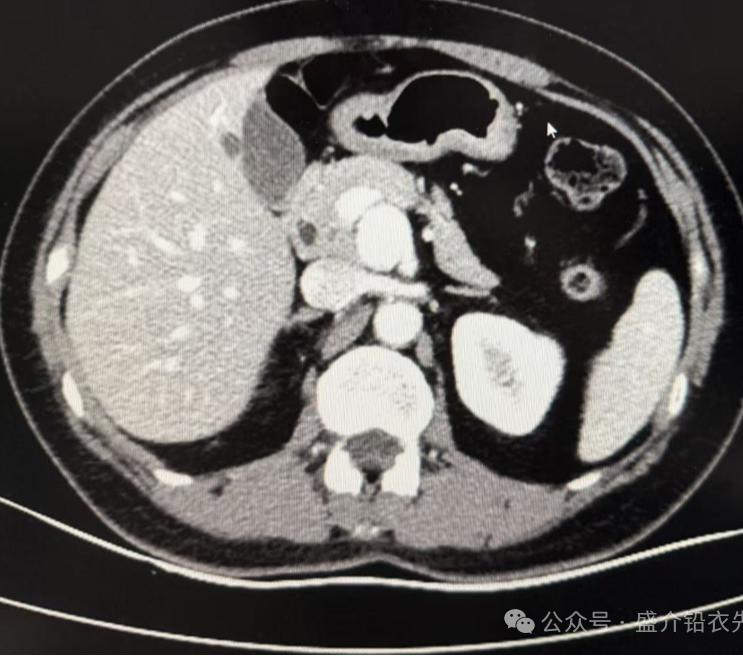 桡动脉鞘怎么读桡胜一筹丨牛猛教授团队：应用Brite Tip RADIANZ长鞘经桡动脉入路治疗脾动脉瘤一例_https://www.jmylbn.com_新闻资讯_第6张