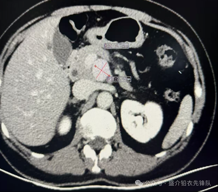 桡动脉鞘怎么读桡胜一筹丨牛猛教授团队：应用Brite Tip RADIANZ长鞘经桡动脉入路治疗脾动脉瘤一例_https://www.jmylbn.com_新闻资讯_第7张
