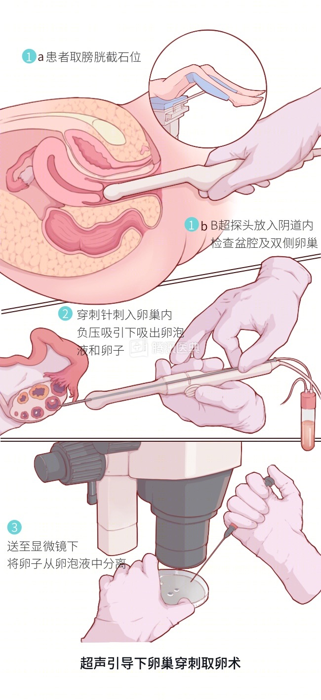 取卵针长什么样取卵针辣么长长长......无痛取卵真的不痛吗？_https://www.jmylbn.com_新闻资讯_第5张
