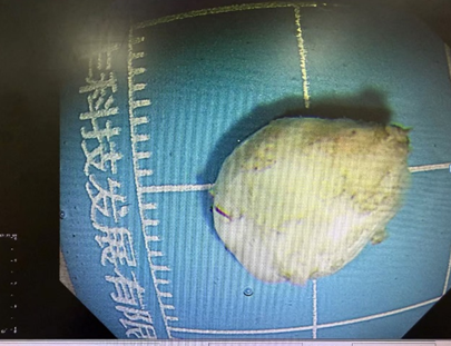 b超md是什么意思【红星科普】当胃镜遇上B超：揭秘身体里的“透视侦探”——超声内镜_https://www.jmylbn.com_新闻资讯_第3张