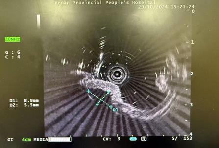 b超md是什么意思【红星科普】当胃镜遇上B超：揭秘身体里的“透视侦探”——超声内镜_https://www.jmylbn.com_新闻资讯_第2张