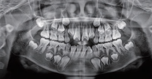 曲面断层片怎么看换牙与身高有关吗？关于孩子换牙的所有疑问一篇说清_https://www.jmylbn.com_新闻资讯_第25张