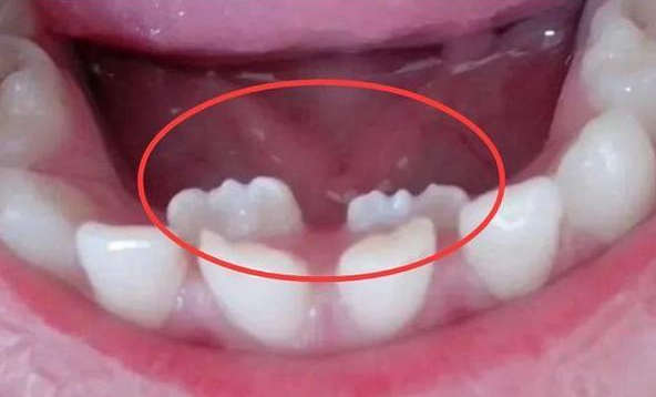 曲面断层片怎么看换牙与身高有关吗？关于孩子换牙的所有疑问一篇说清_https://www.jmylbn.com_新闻资讯_第14张