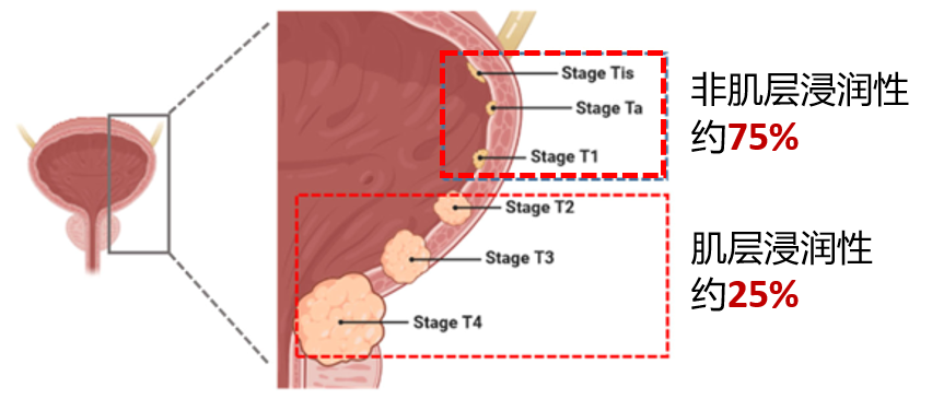 医讯怎么用『附一医讯』频繁血尿，一查竟是高危膀胱癌，福医附一医院泌尿外科新诊疗模式助力 “膀胱保卫战”，不用切除膀胱也能治愈肿瘤_https://www.jmylbn.com_新闻资讯_第13张