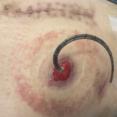 医讯怎么用『附一医讯』频繁血尿，一查竟是高危膀胱癌，福医附一医院泌尿外科新诊疗模式助力 “膀胱保卫战”，不用切除膀胱也能治愈肿瘤_https://www.jmylbn.com_新闻资讯_第4张