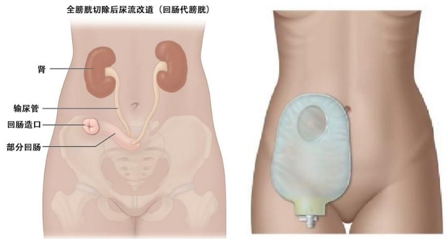 医讯怎么用『附一医讯』频繁血尿，一查竟是高危膀胱癌，福医附一医院泌尿外科新诊疗模式助力 “膀胱保卫战”，不用切除膀胱也能治愈肿瘤_https://www.jmylbn.com_新闻资讯_第3张