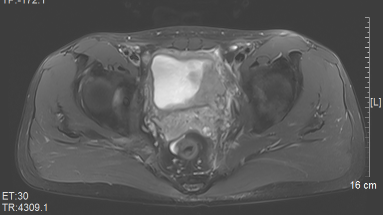 医讯怎么用『附一医讯』频繁血尿，一查竟是高危膀胱癌，福医附一医院泌尿外科新诊疗模式助力 “膀胱保卫战”，不用切除膀胱也能治愈肿瘤_https://www.jmylbn.com_新闻资讯_第8张