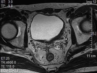 医讯怎么用『附一医讯』频繁血尿，一查竟是高危膀胱癌，福医附一医院泌尿外科新诊疗模式助力 “膀胱保卫战”，不用切除膀胱也能治愈肿瘤_https://www.jmylbn.com_新闻资讯_第9张