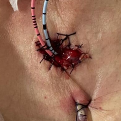 医讯怎么用『附一医讯』频繁血尿，一查竟是高危膀胱癌，福医附一医院泌尿外科新诊疗模式助力 “膀胱保卫战”，不用切除膀胱也能治愈肿瘤_https://www.jmylbn.com_新闻资讯_第5张